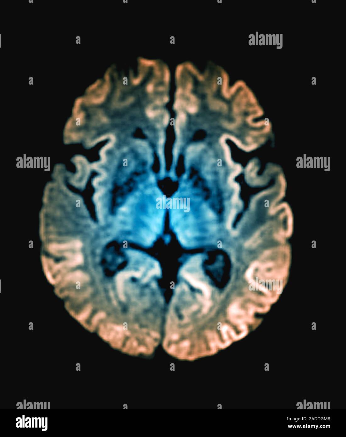 CreutzfeldtJakob disease. Coloured axial resonance imaging