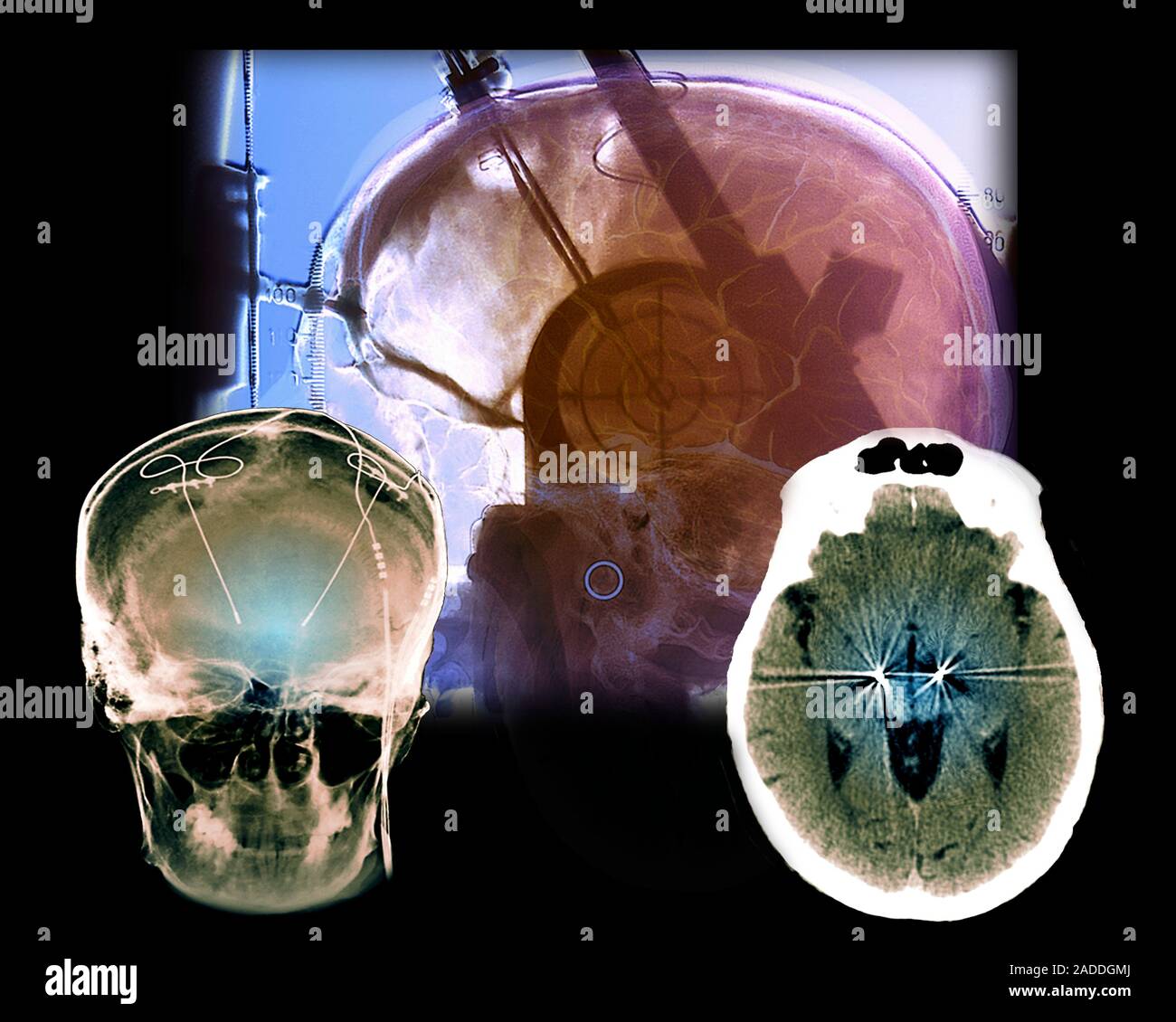 Parkinson's disease brain stimulation operation. X-rays and a computed ...
