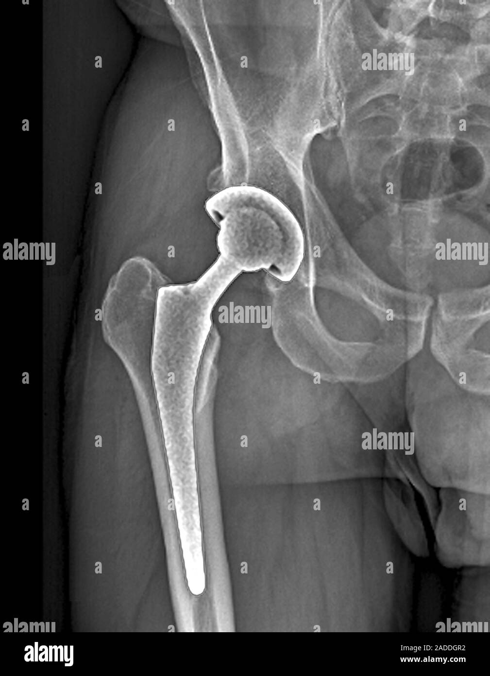 Total hip replacement. Frontal Xray of the right hip of a 54yearold