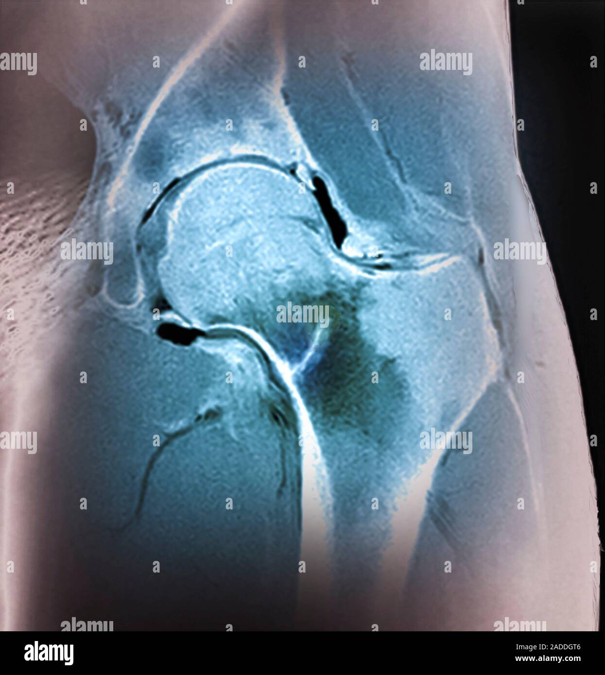 Hip stress fracture. Coloured coronal resonance imaging (MRI