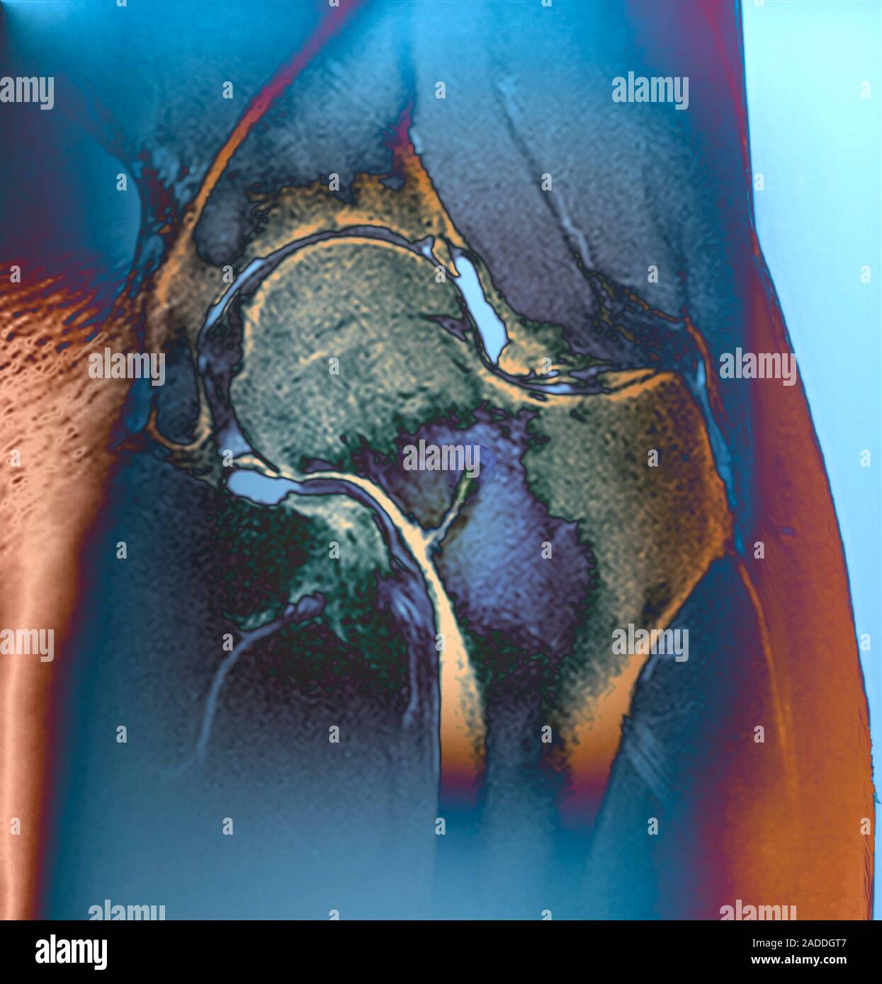 Hip stress fracture. Coloured coronal resonance imaging (MRI