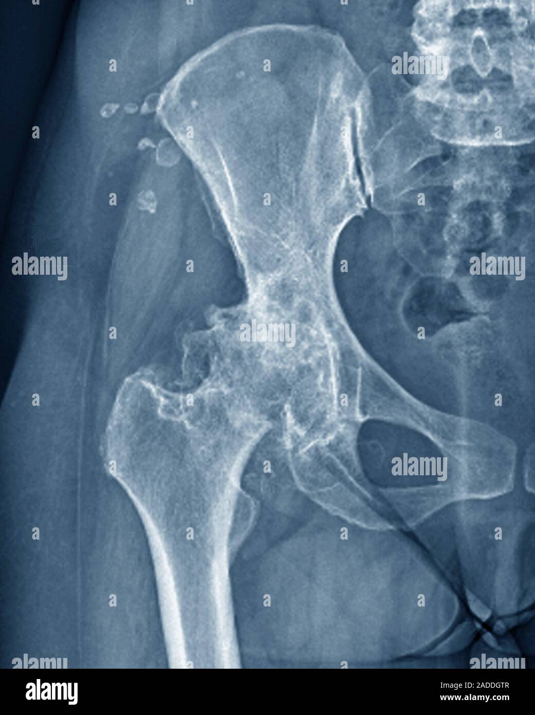 Osteoarthritis of the hip. Frontal X-ray of the right hip of a 57-year ...