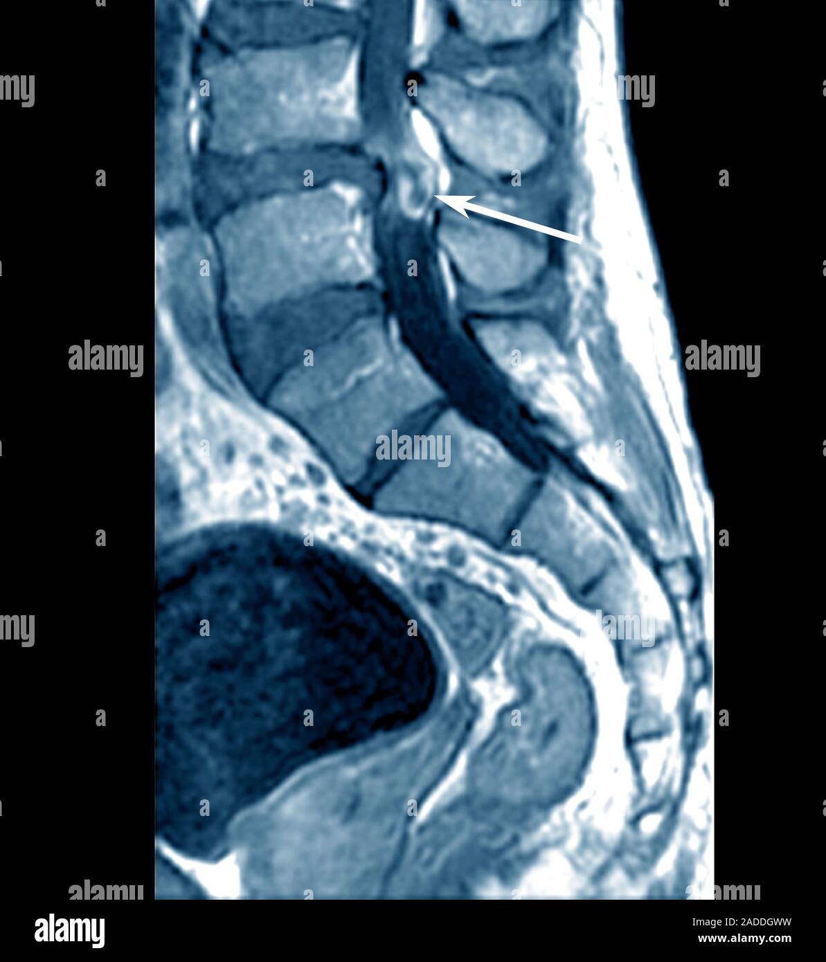 Slipped disc in the lumbar spine. Sagittal magnetic resonance imaging ...