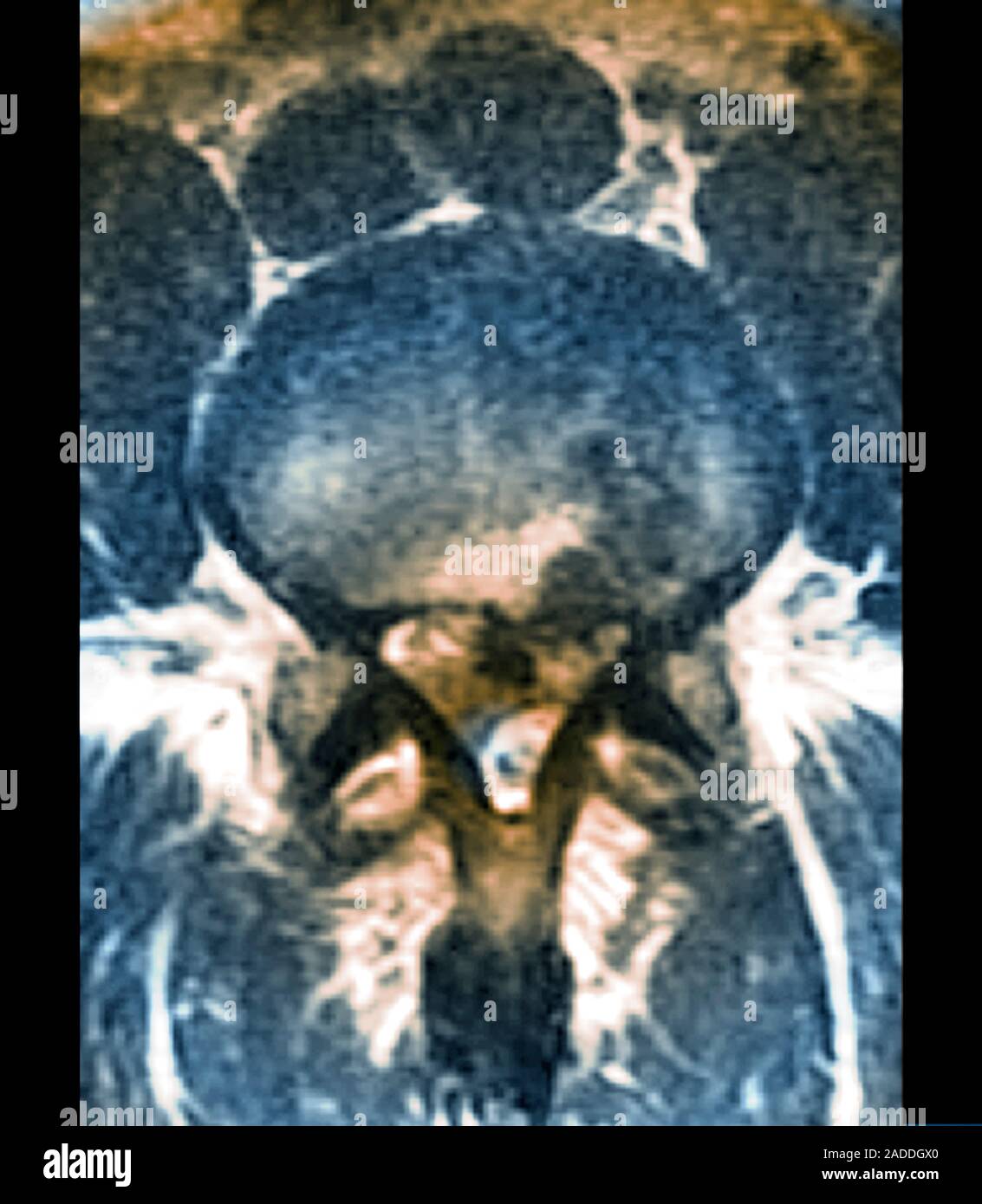 Slipped disc in the lumbar spine. Coloured axial resonance