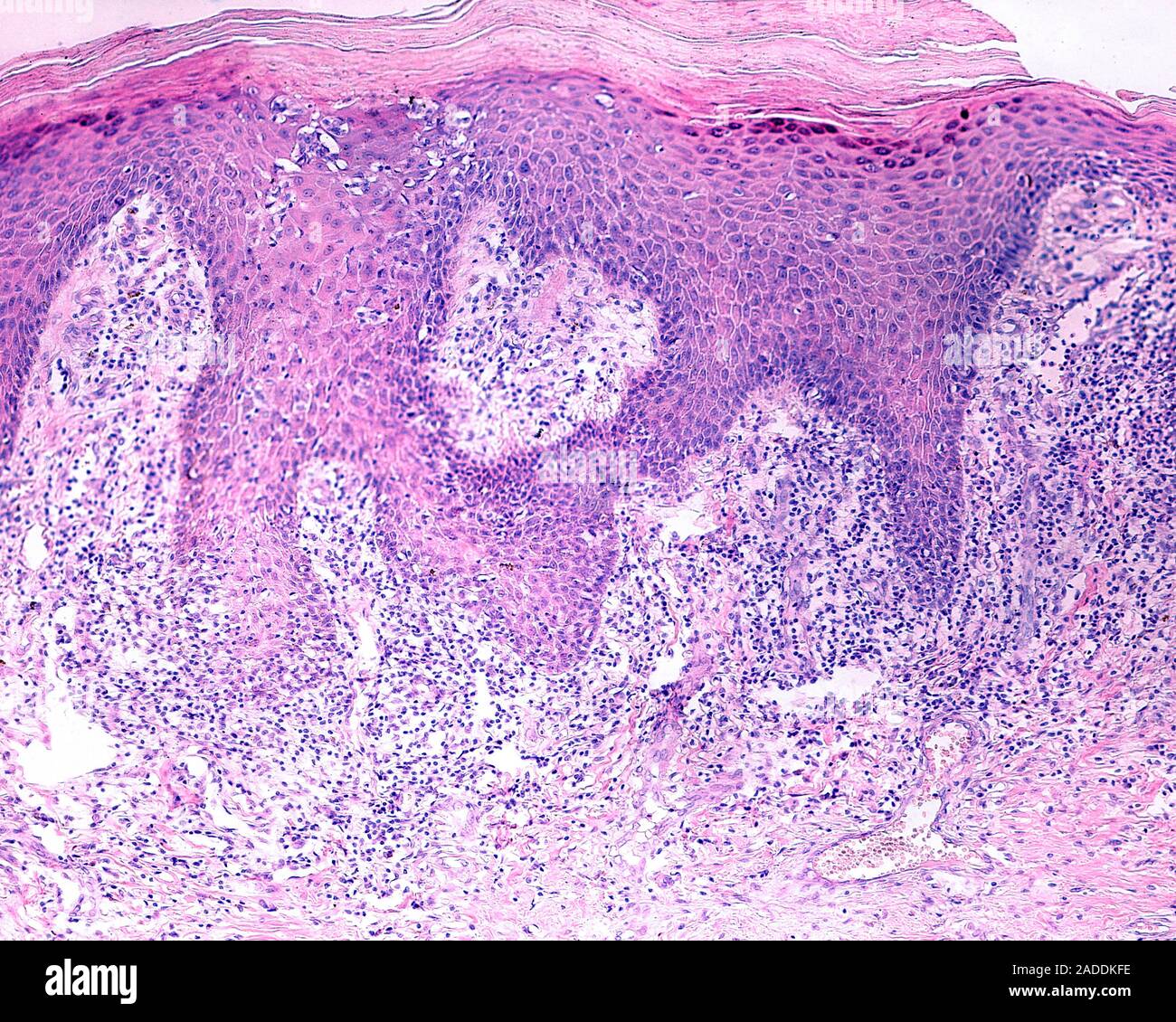 Light Micrograph Of A Section Through Human Skin With Lichen Planus It