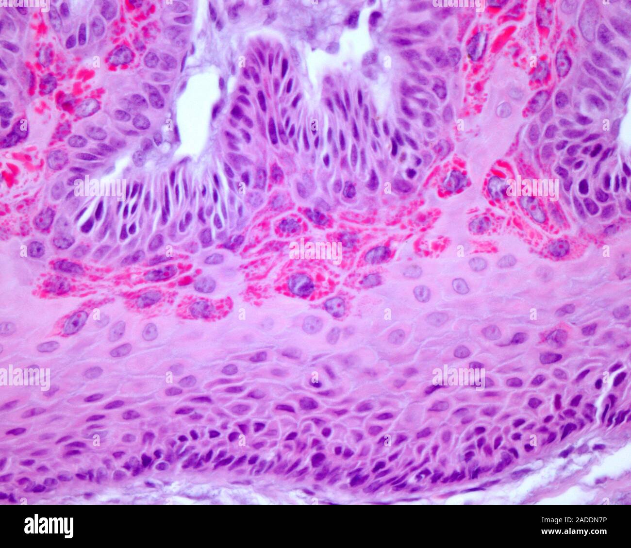 Molluscum contagiosum, light micrograph. Molluscum contagiosum is a skin viral infection characterized by eosinophilic inclusion bodies (Henderson-Pat Stock Photo