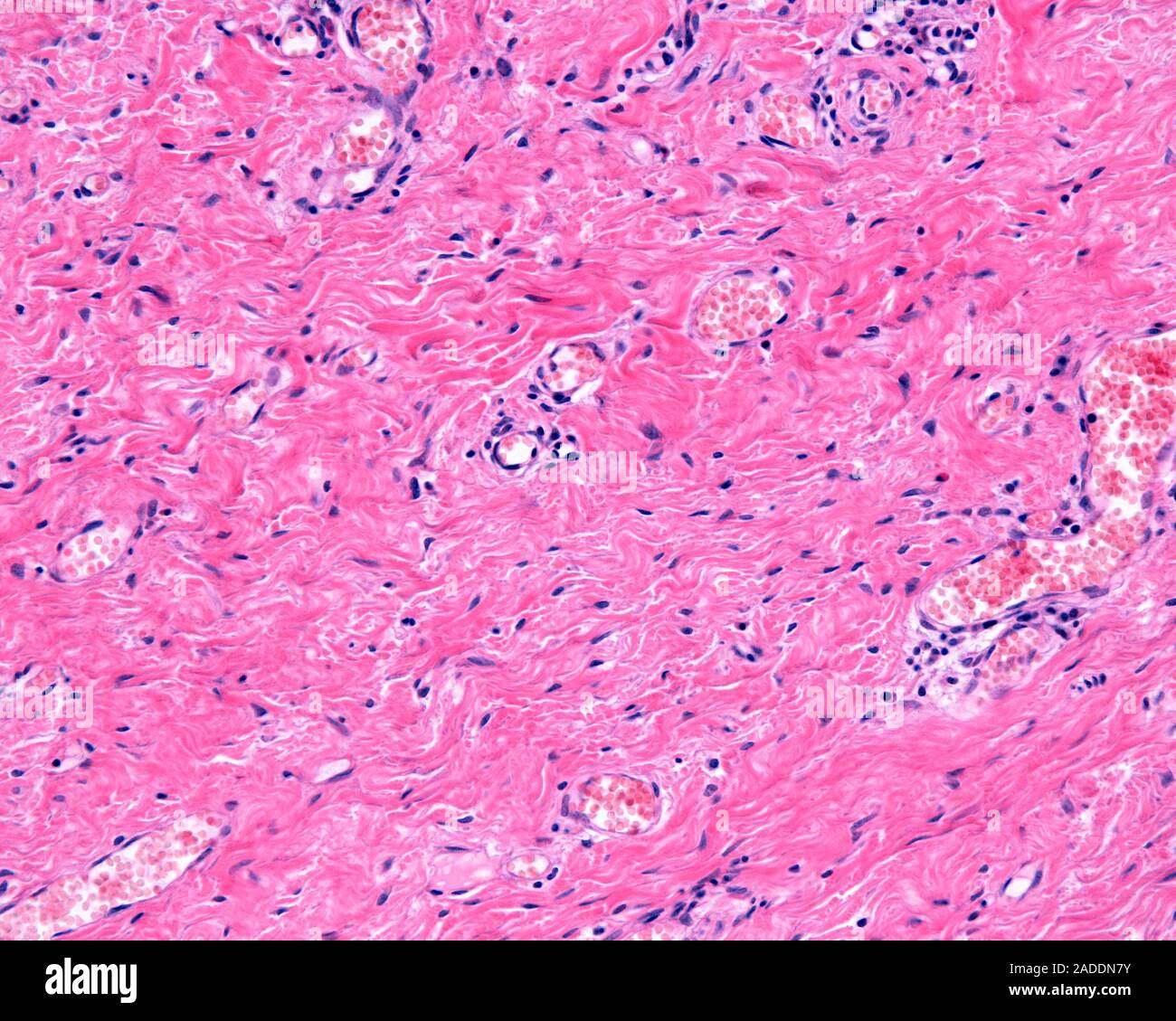 Dermis reticular of skin, light micrograph. The reticular dermis is a ...