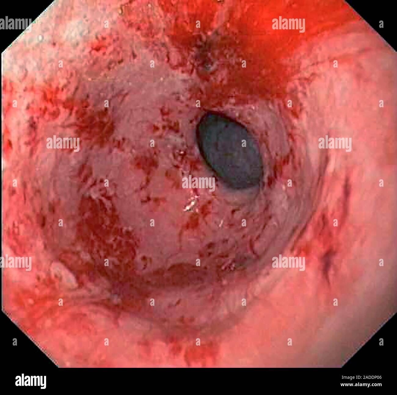 Gastric antral vascular ectasia. Endoscope view of the antrum (final