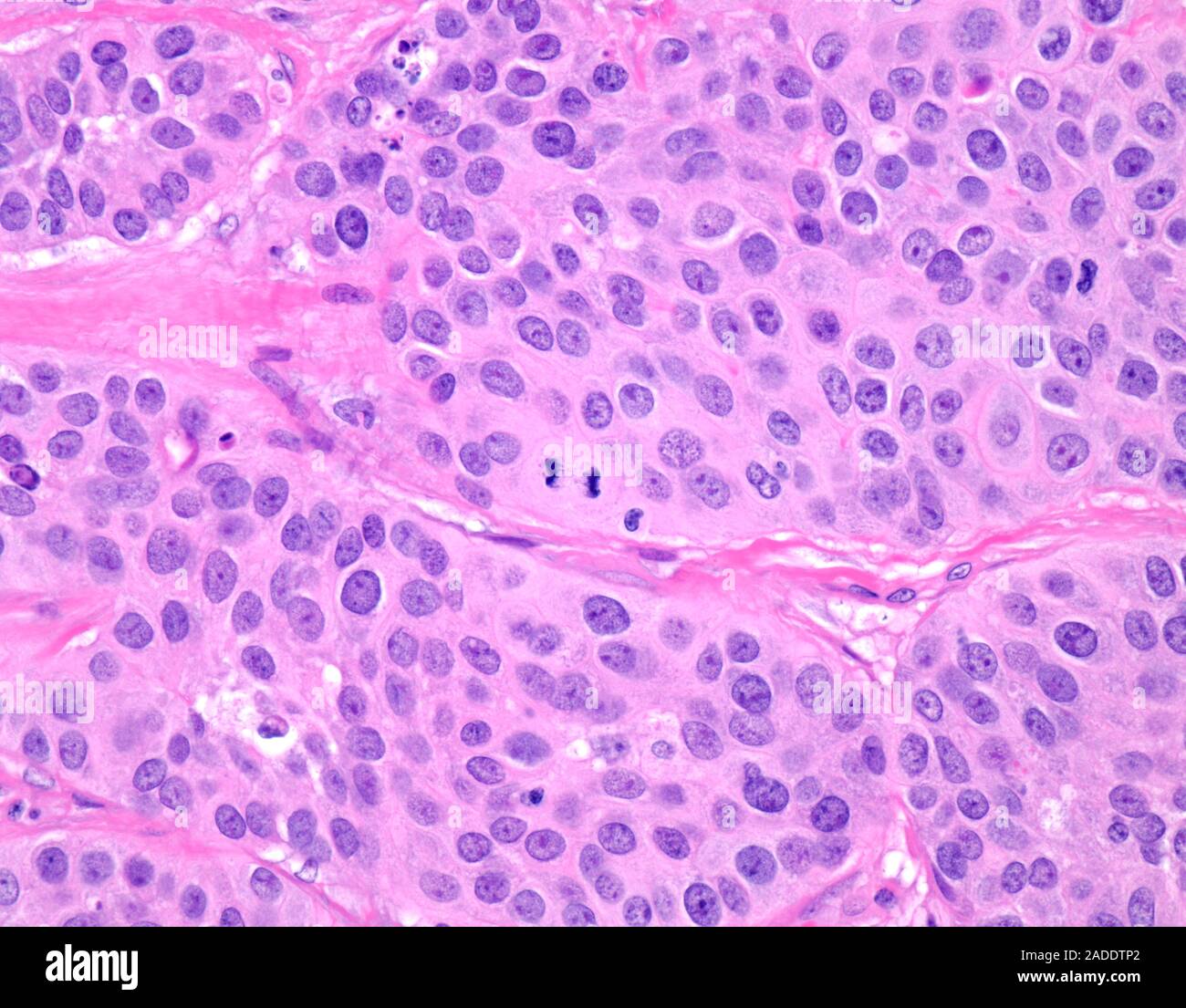 Light micrograph of high-grade urothelial carcinoma (also known as ...
