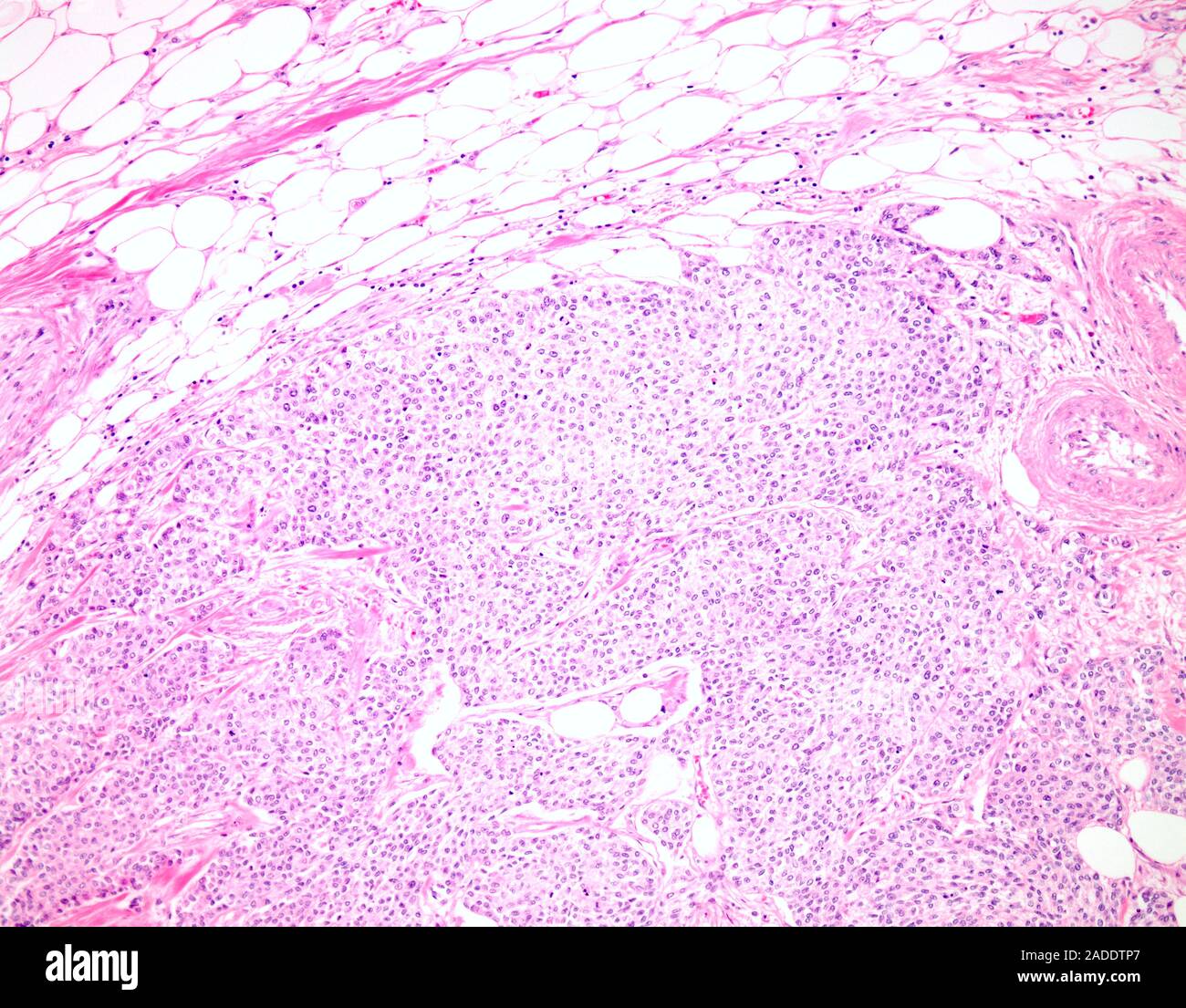 Light micrograph of high-grade papillary urothelial carcinoma (also ...