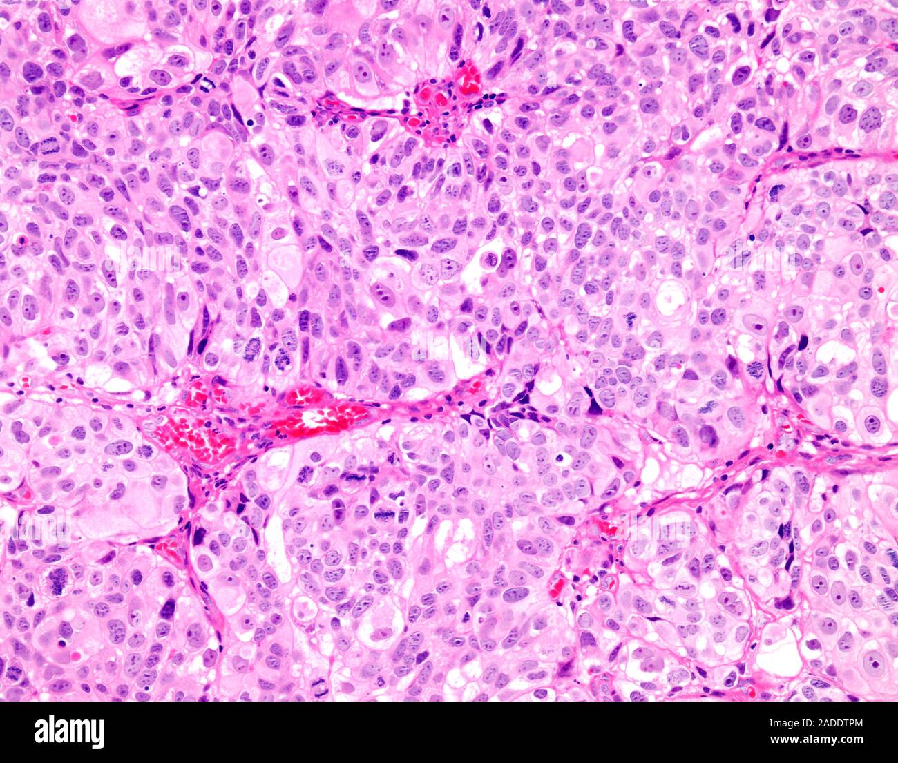 Light micrograph of high-grade papillary urothelial carcinoma (also ...