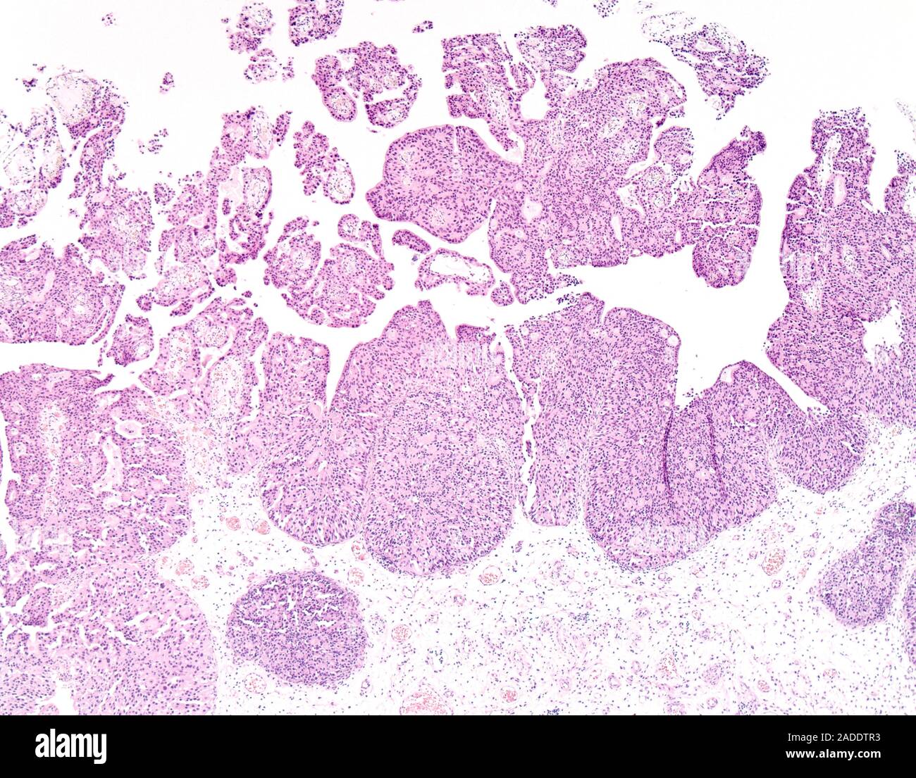 Light micrograph of non-invasive high-grade papillary urothelial ...