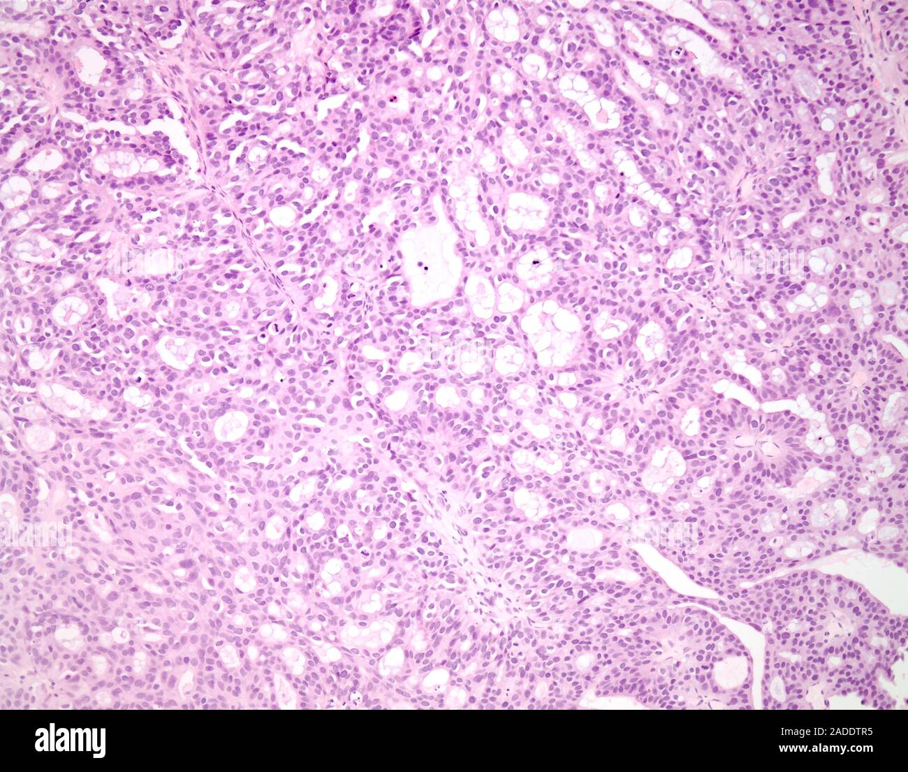 Light micrograph of urothelial carcinoma with gland-like spaces, also ...