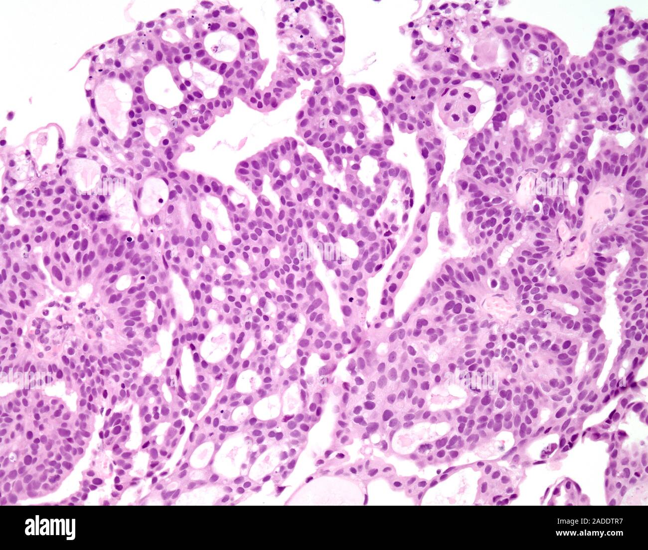 Light micrograph of urothelial carcinoma with gland-like spaces, also ...