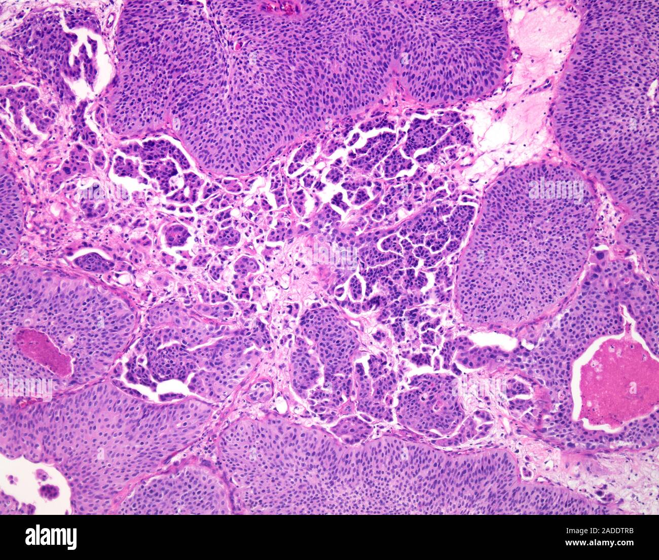 Light micrograph of high-grade papillary urothelial carcinoma (also ...