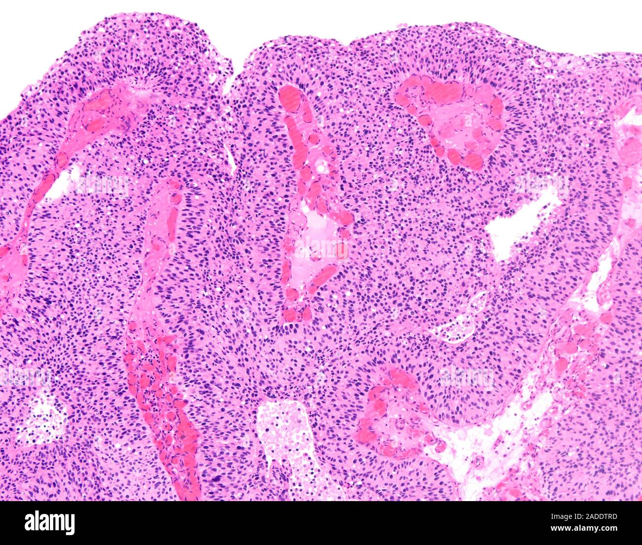 Light micrograph of high-grade papillary urothelial carcinoma (also ...