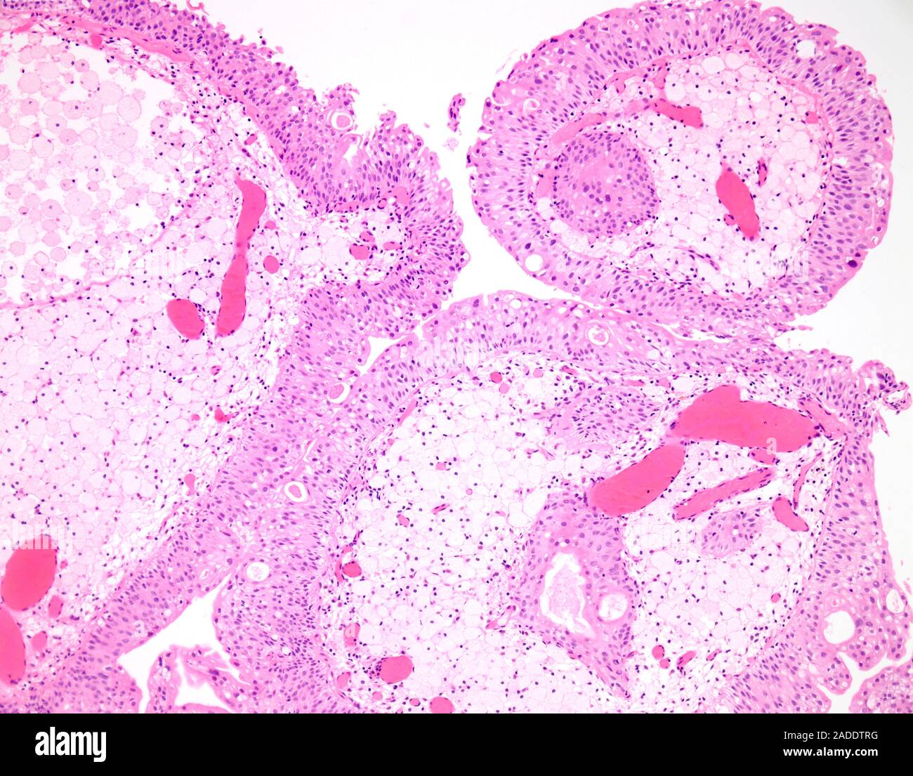 Light micrograph of low-grade papillary urothelial carcinoma. The tumor ...