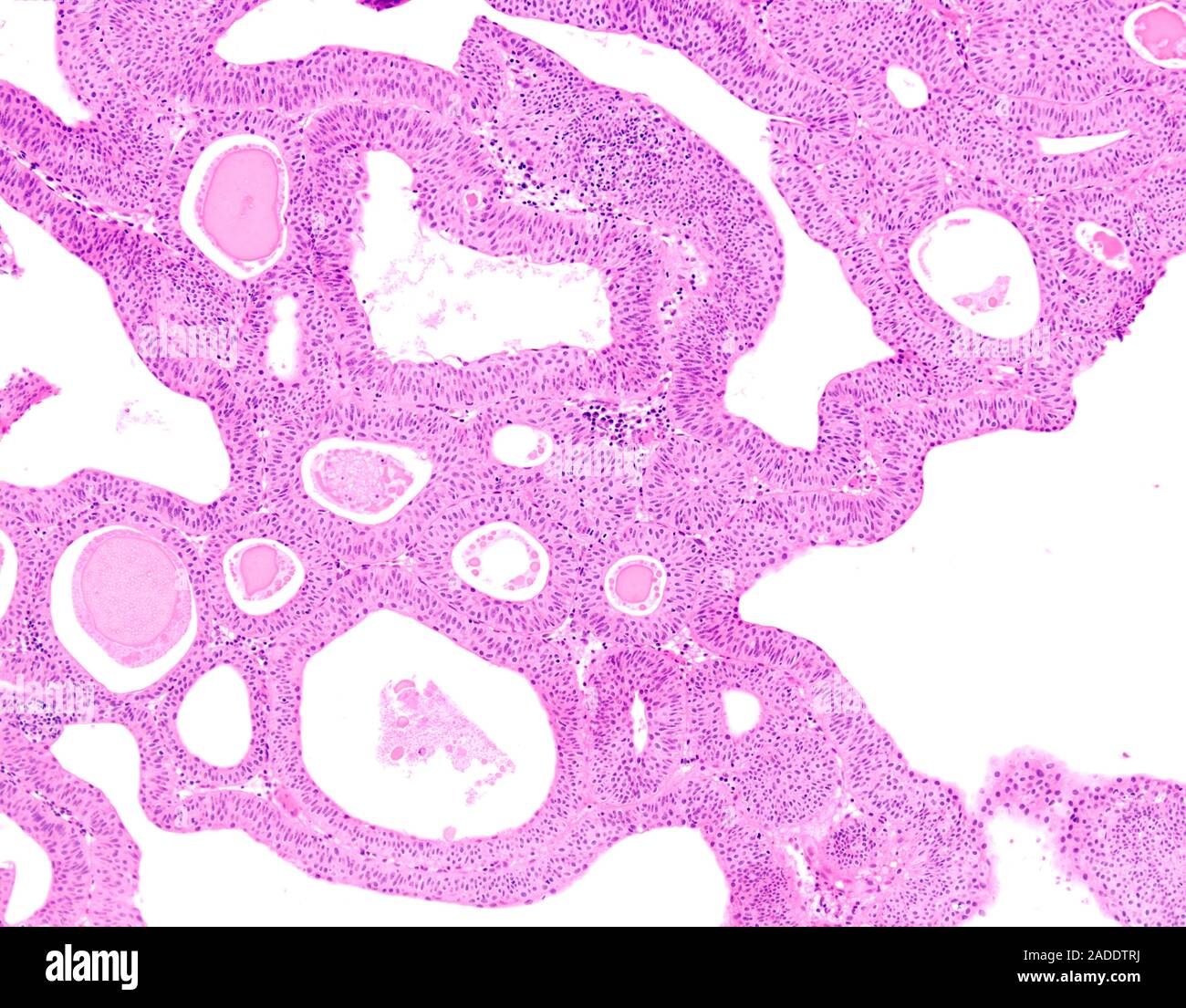 Light micrograph of low-grade papillary urothelial carcinoma (also ...