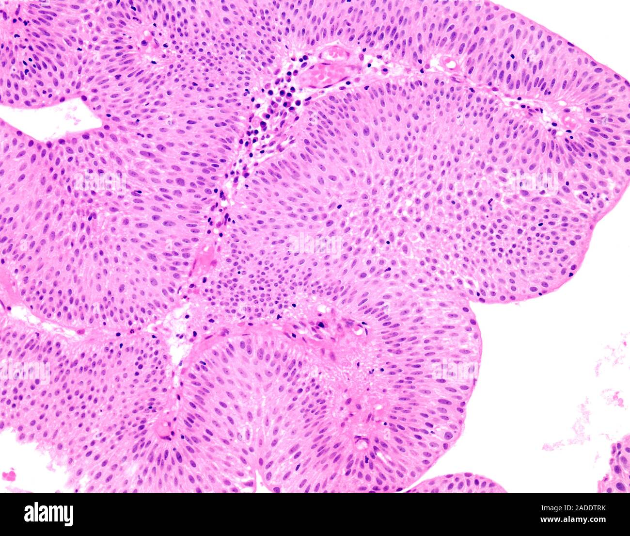Light micrograph of low-grade papillary urothelial carcinoma (also ...