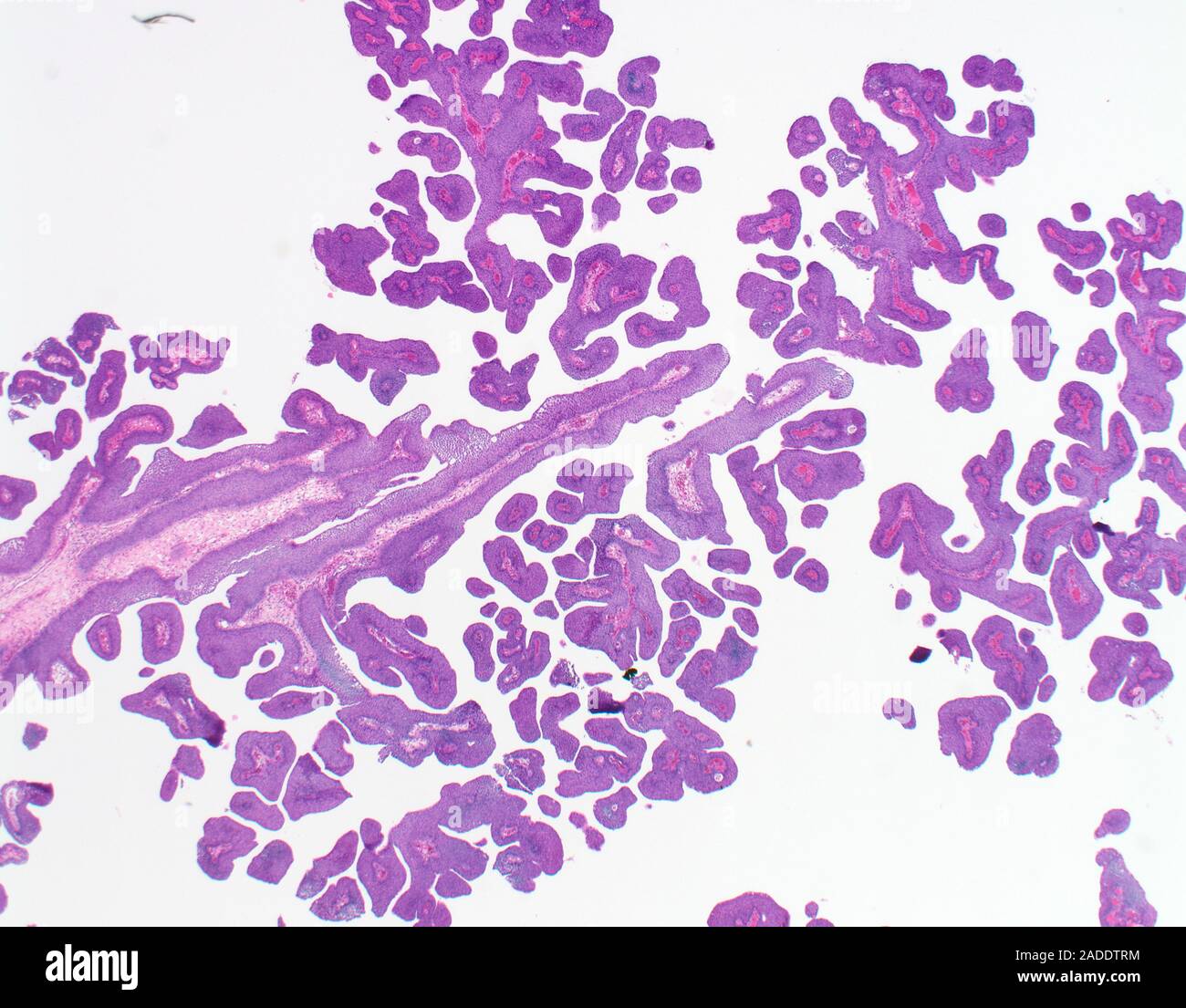 Light micrograph of low-grade papillary urothelial carcinoma (also ...