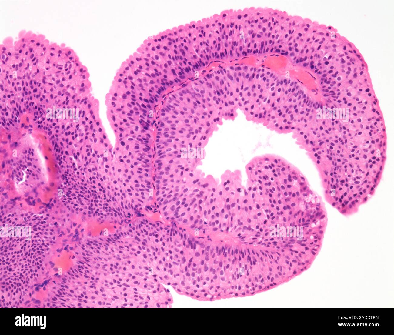 Light micrograph of low-grade papillary urothelial carcinoma (also ...