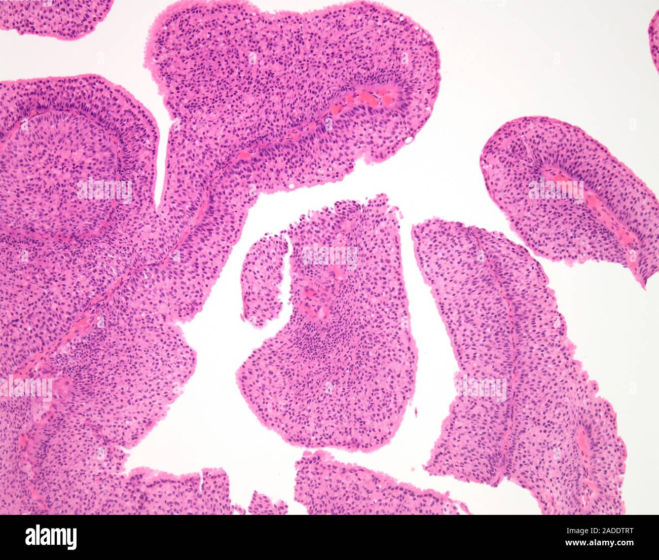 Light micrograph of low-grade papillary urothelial carcinoma (also ...