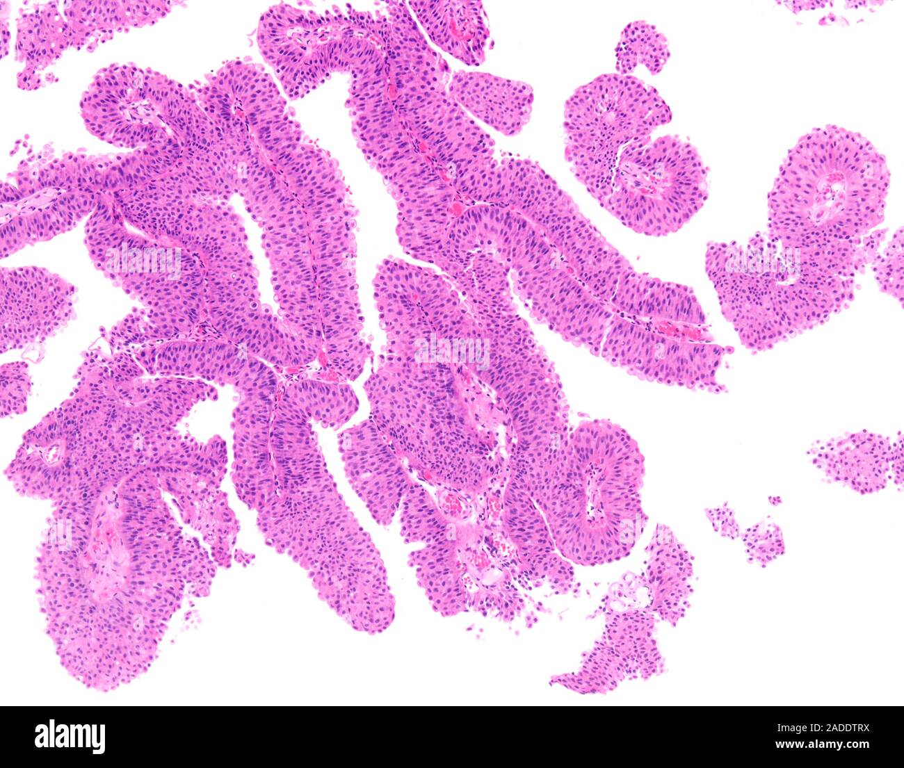 Light micrograph of low-grade papillary urothelial carcinoma (also ...