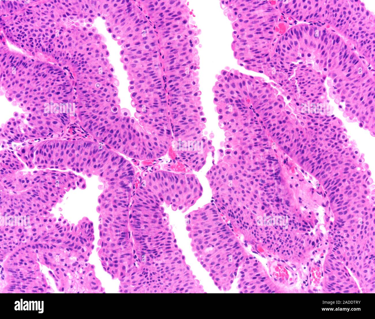 Light micrograph of low-grade papillary urothelial carcinoma (also ...