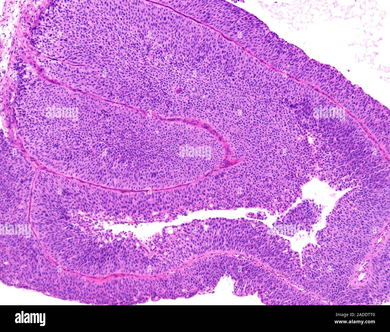 Light micrograph of low-grade papillary urothelial carcinoma (also ...