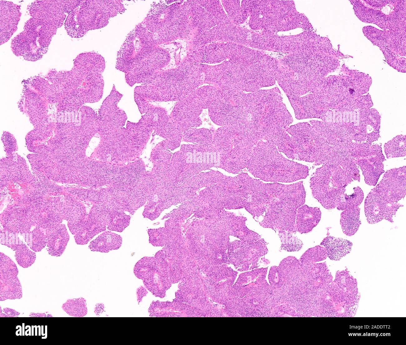 Light micrograph of low-grade papillary urothelial carcinoma (also ...