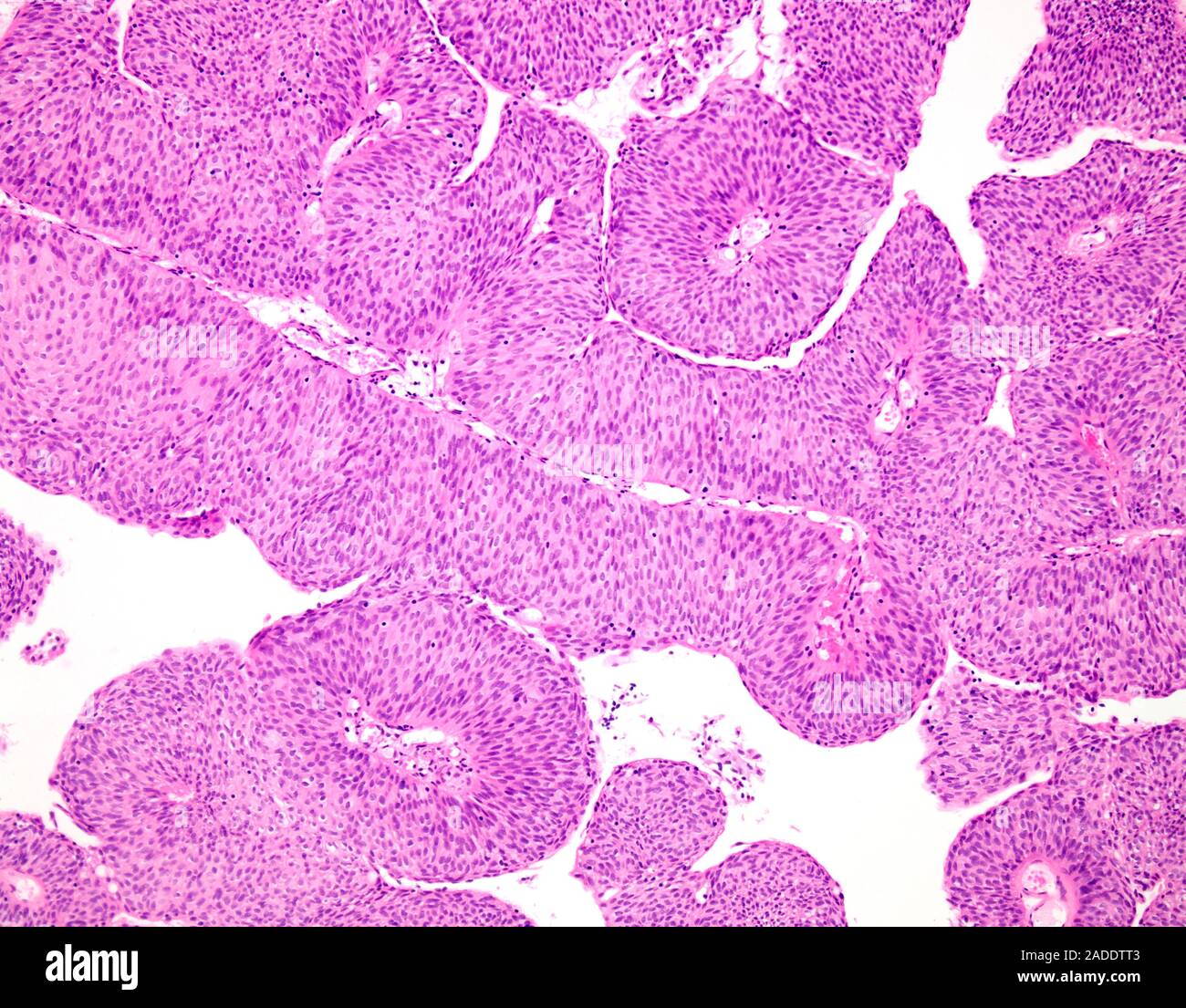 Light micrograph of low-grade papillary urothelial carcinoma (also ...