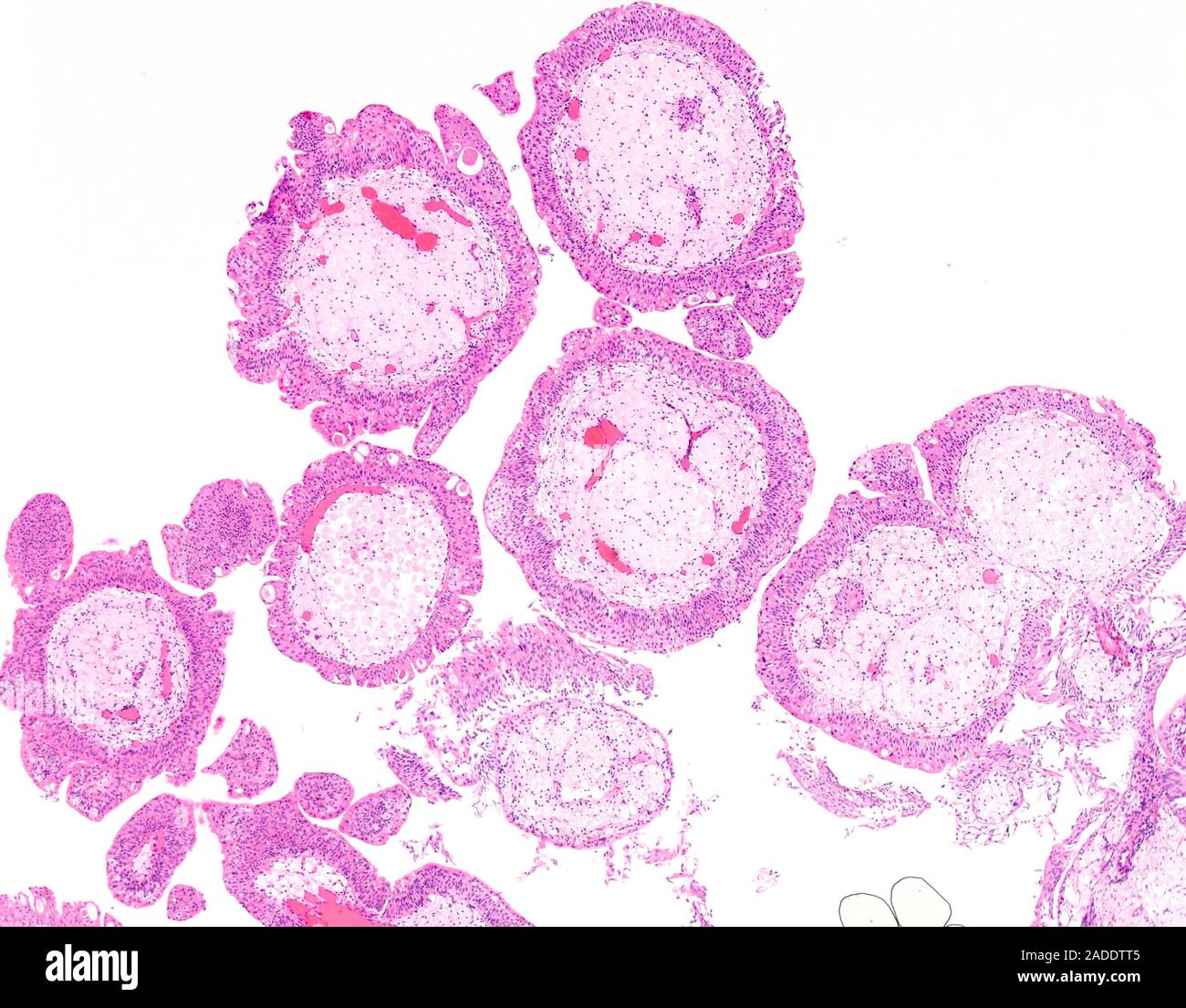 Light micrograph of low-grade papillary urothelial carcinoma. The tumor ...