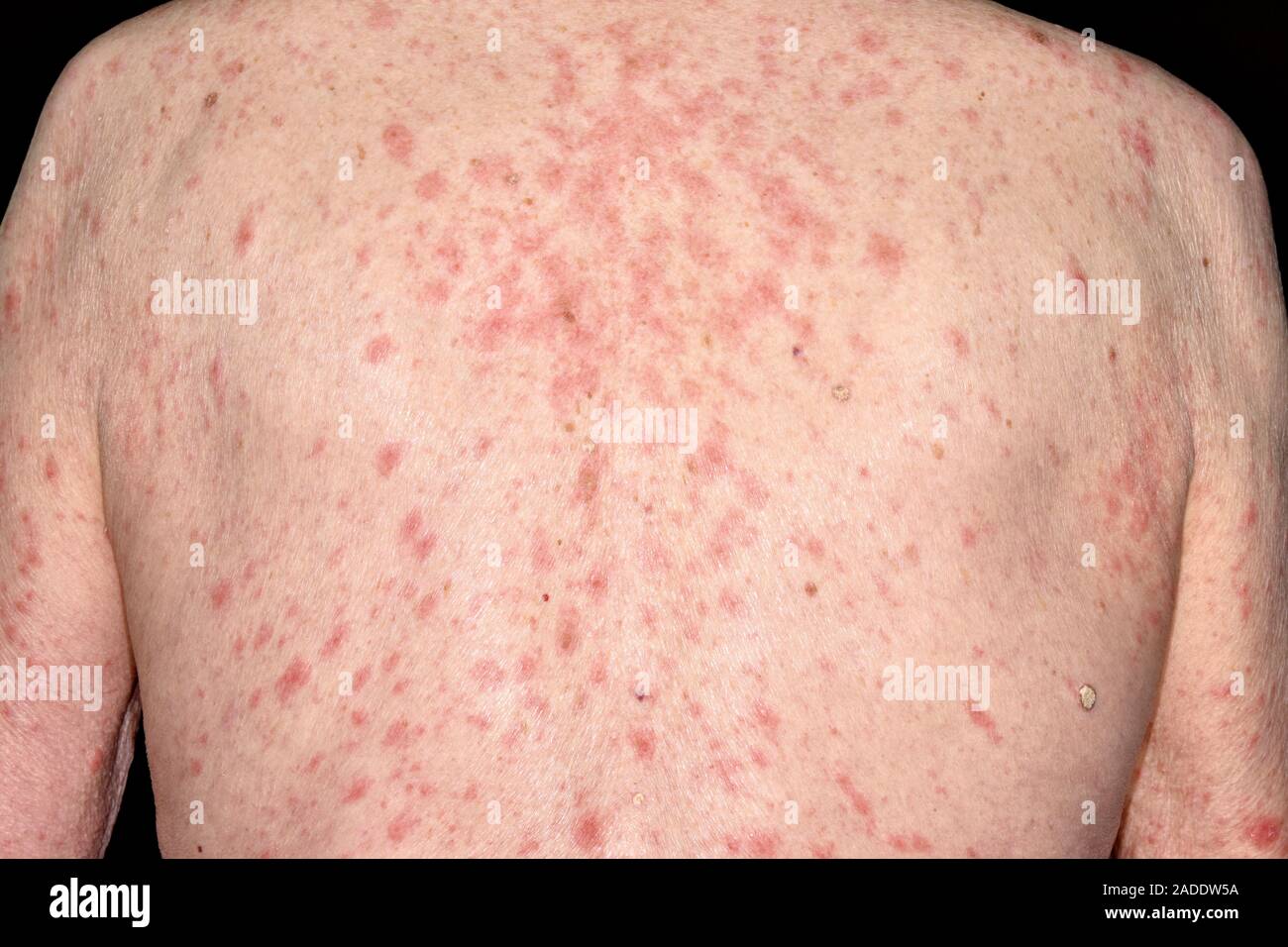 Drug allergy reaction. Closeup of a rash on the back of a 91yearold