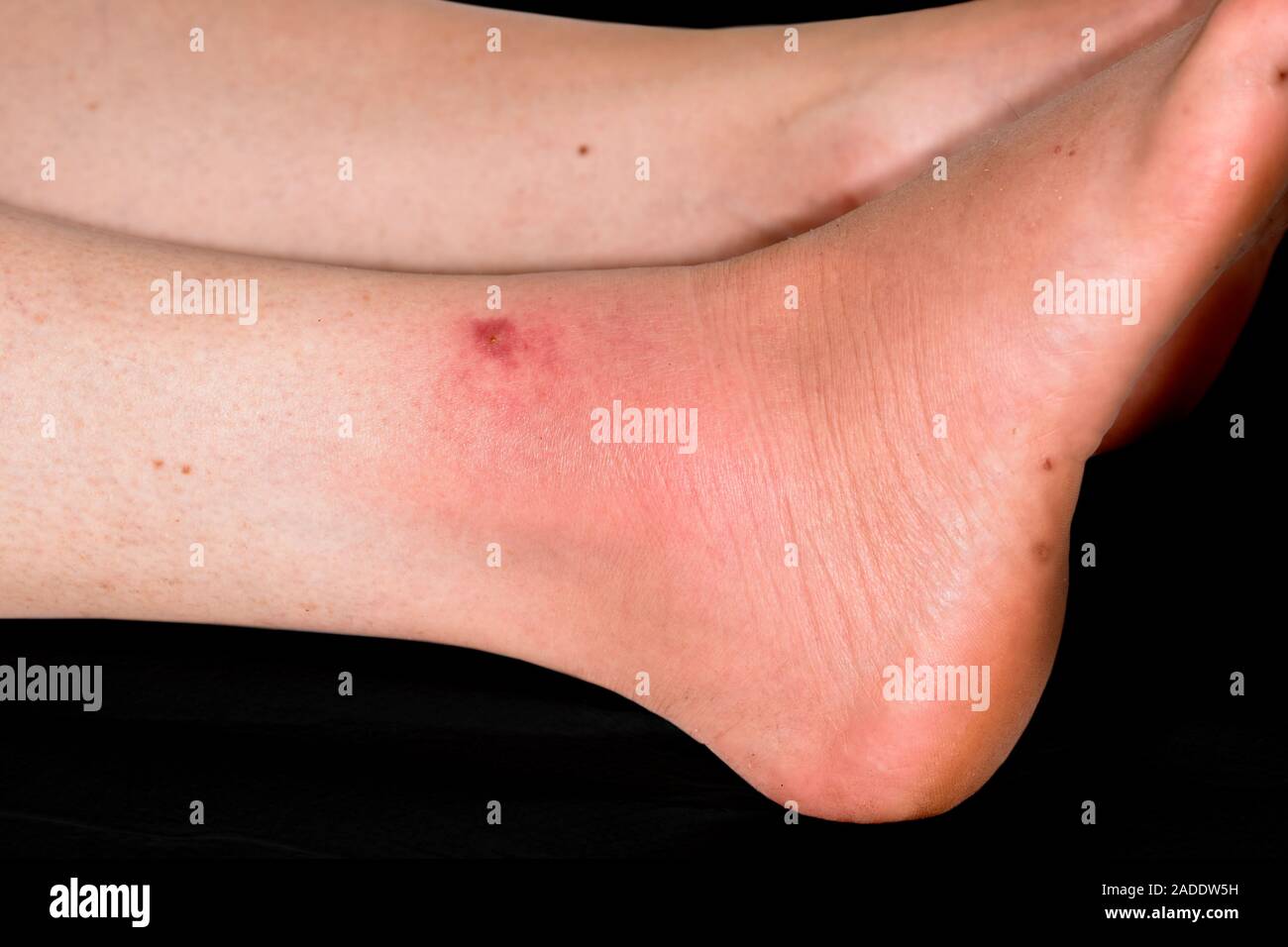 Swelling from insect bite. Closeup of the ankle of a 44yearold