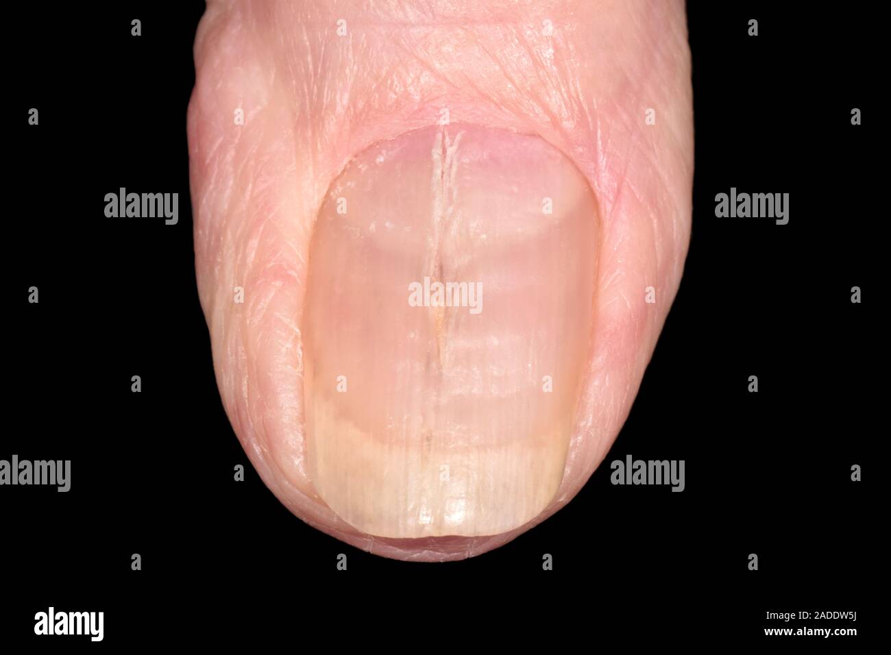 Details more than 126 eczema nail ridges best