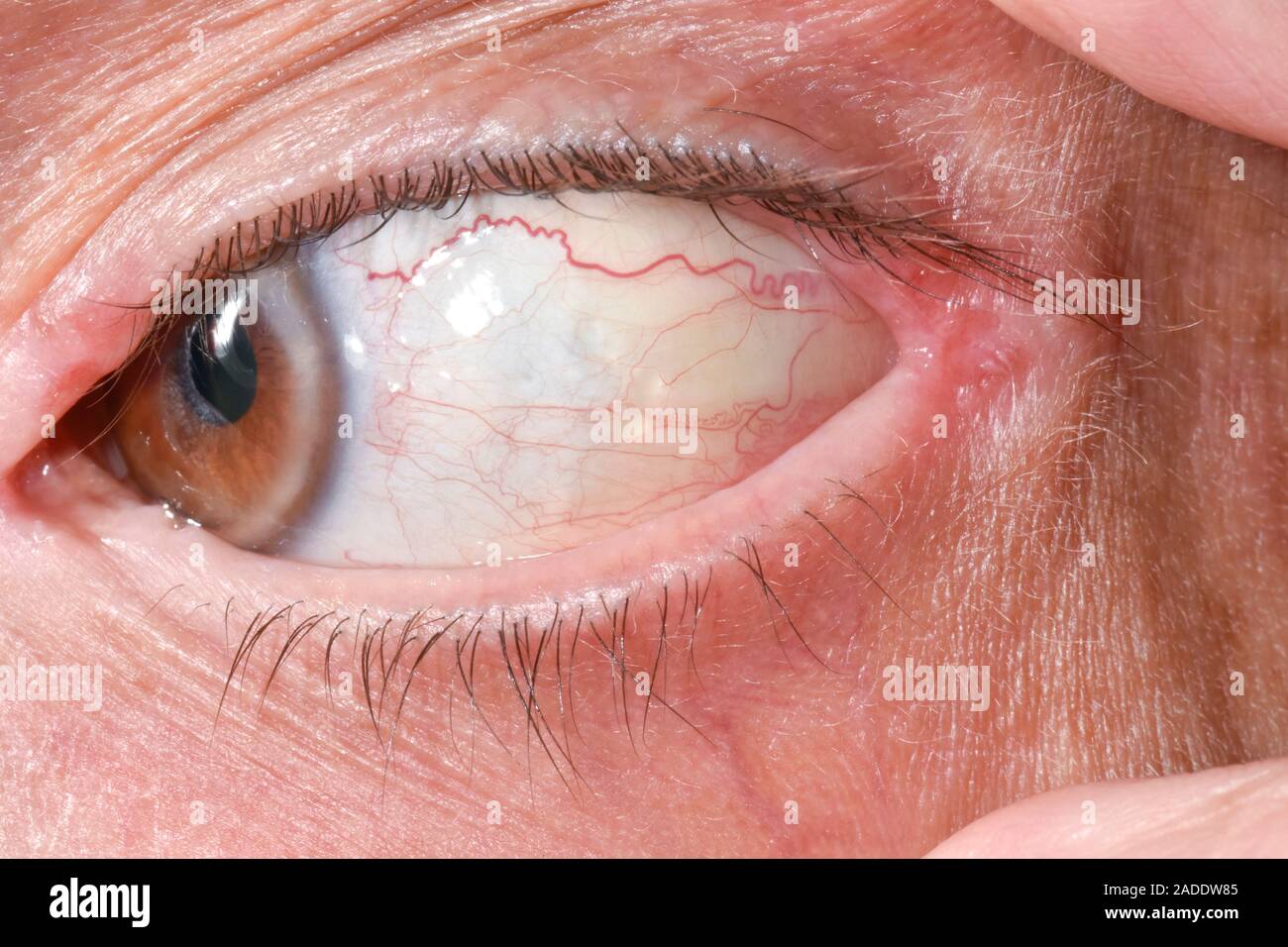 Conjunctival retention cysts. Closeup of the eye of a 63yearold