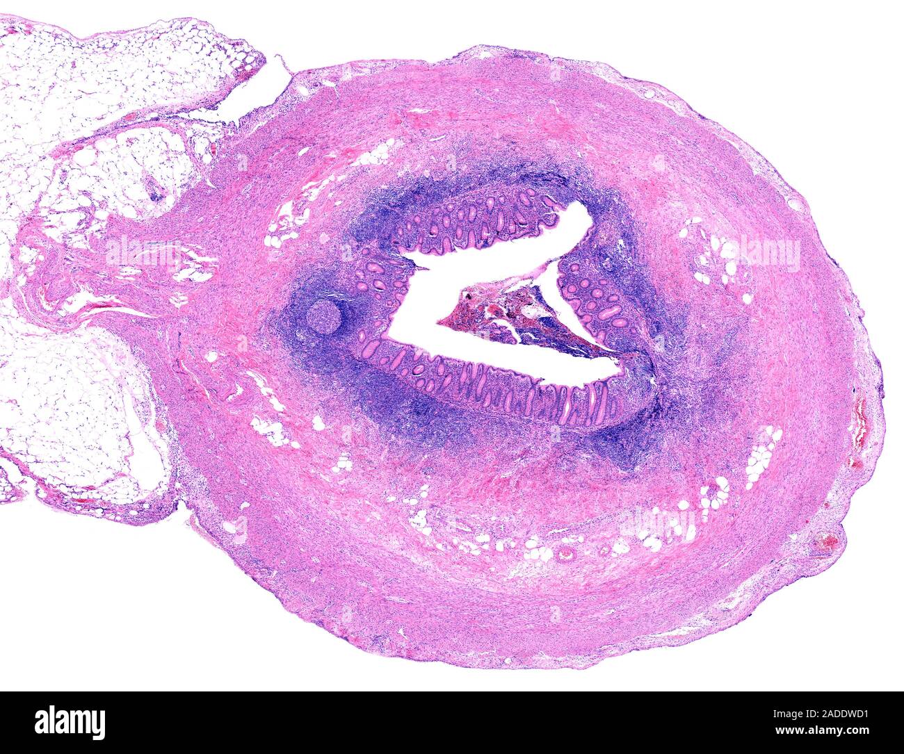 Light micrograph of a cross section through an appendix removed due to ...