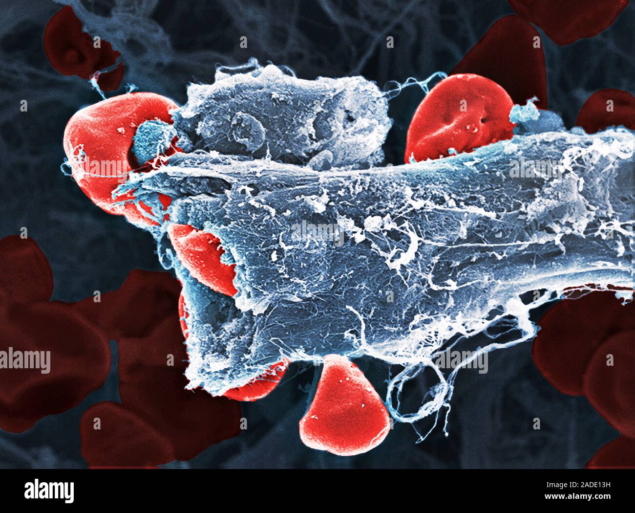 Images not to be used by the tobacco industry. Ruptured blood vessel ...