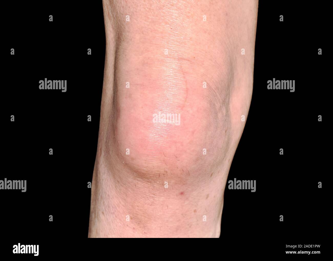Swollen knee. 73yearold woman's swollen knee. The swelling is of a