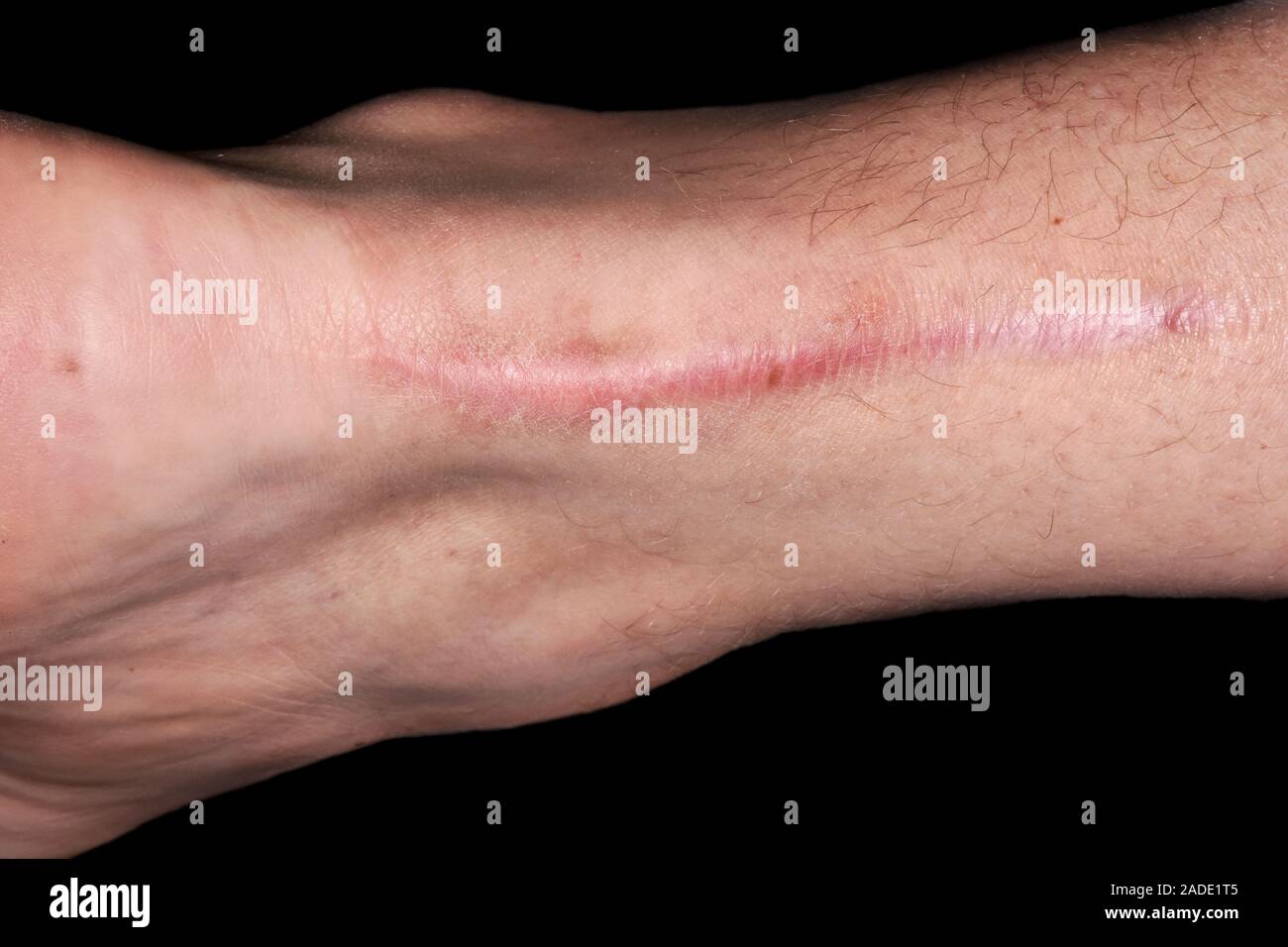 scar-from-achilles-tendon-surgery-to-repair-an-injury-in-a-41-year-old