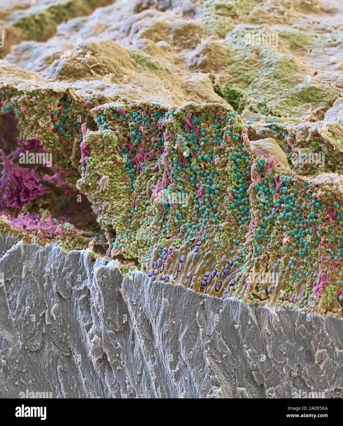 Plaque on tooth. Coloured scanning electron micrograph (SEM) showing a