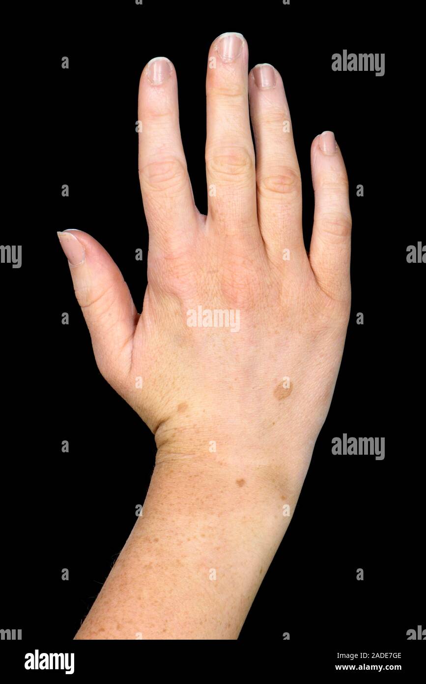 melanotic Labial Lentigo (labial melanotic macule)