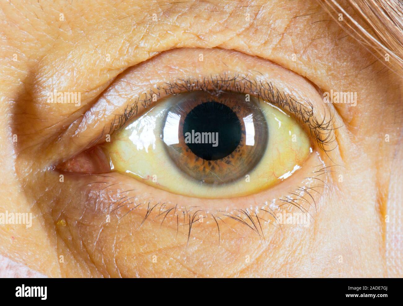 Kayser Fleischer ring in eye due to liver disease. Left eye of a 62 year old woman with Kayser Fleischer rings KF rings and yellowing skin and eyes Stock Photo Alamy