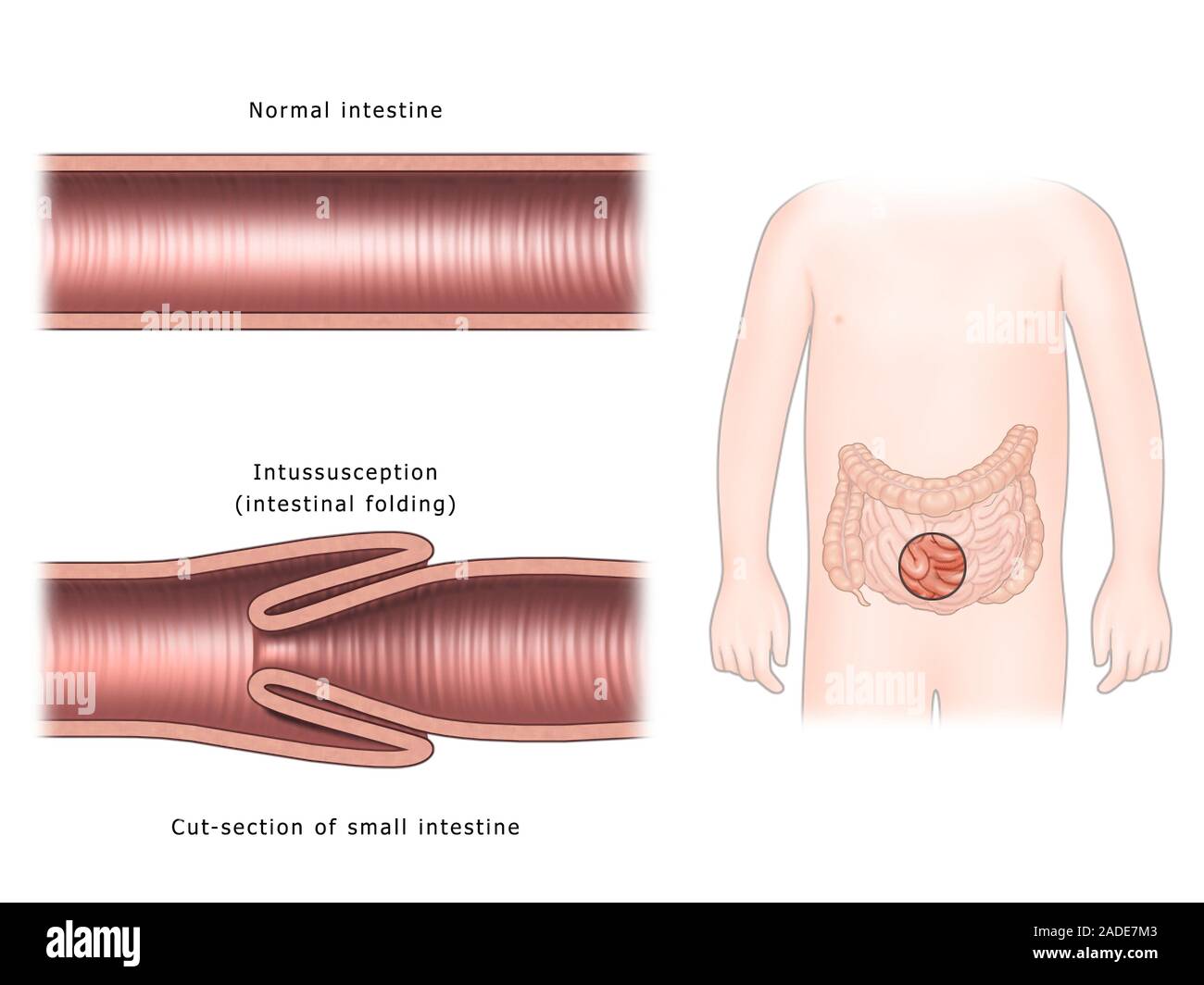 Intussusception of the intestines, illustration. The normal and ...