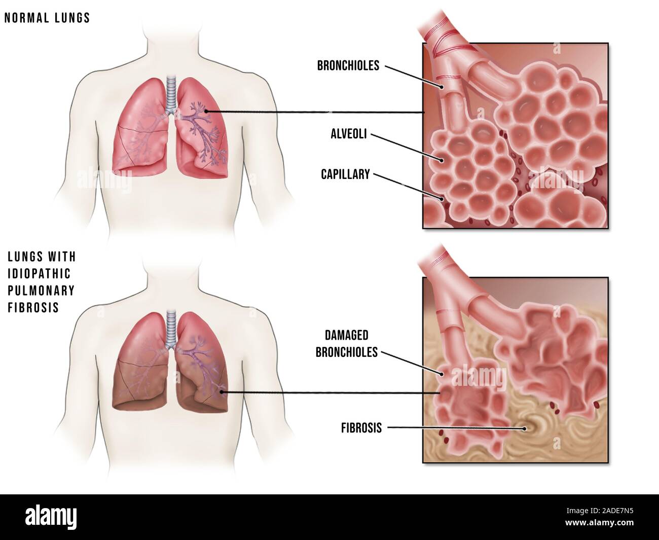 Lung diseases and alveoli, illustration. Normal lungs (top) and ...