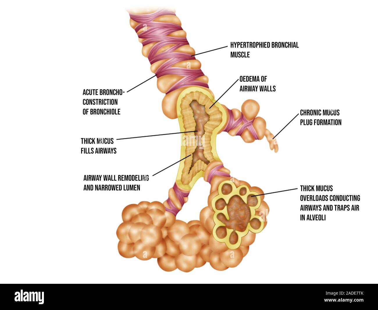Lung bronchioles and alveoli in bronchiolitis, illustration ...