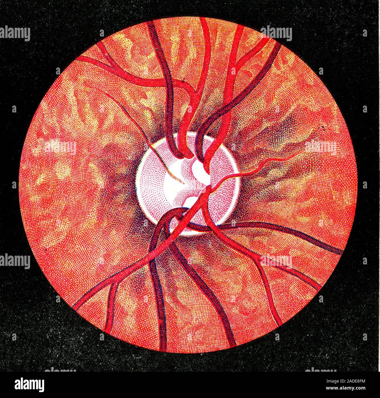 Fundus and optic disc of the eye, historical illustration. The optic ...