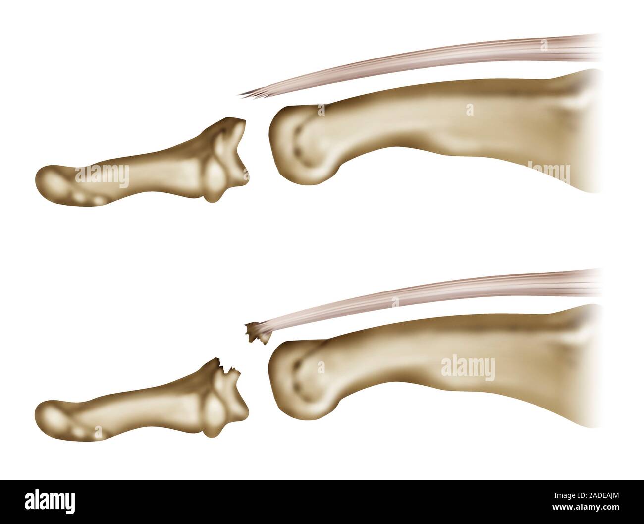 Fingertip tendon injury, illustration. Two types if injuries to the
