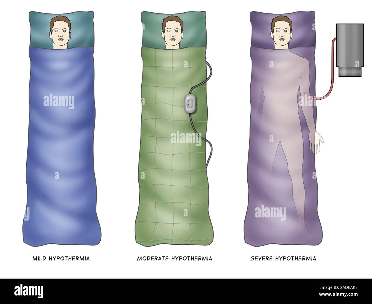 Hypothermia treatments, illustration. From left to right, three forms