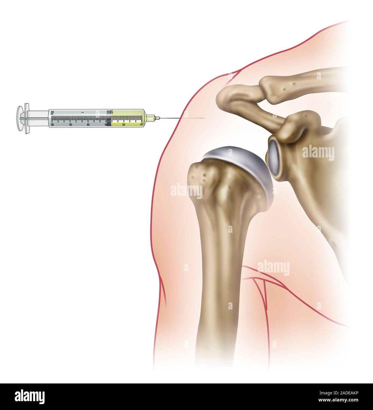 Shoulder Injection Location Chart Shoulder injection, illustration. Syringe being used to inject drugs ...